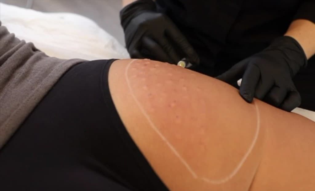 Før og efter Sunekos Cell behandling af appelsinhud