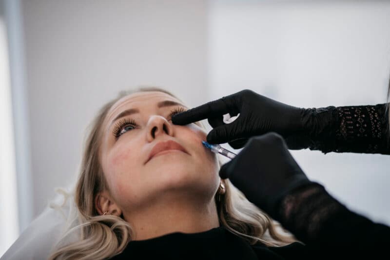 Før og efter behandling af mørke rander under øjnene med Restylane Eyelight