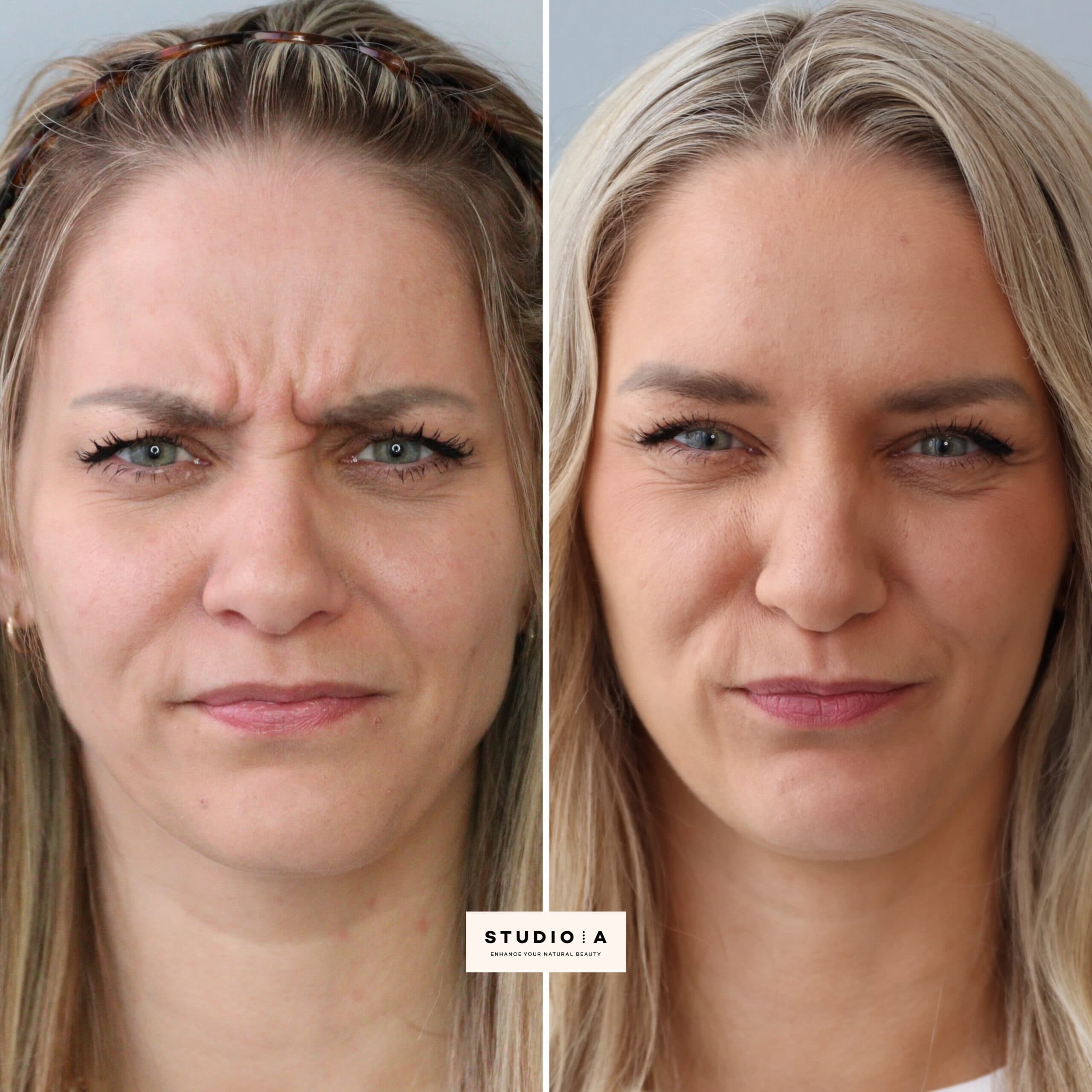 Før og efter botox behandling af bekymringsrynken