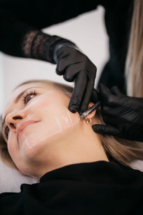 Før og efter kæbe- og hagebehandling med hyaluronsyre-filler