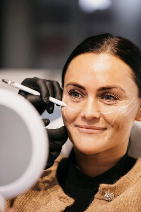 Før og efter kindbenløft med Restylane filler