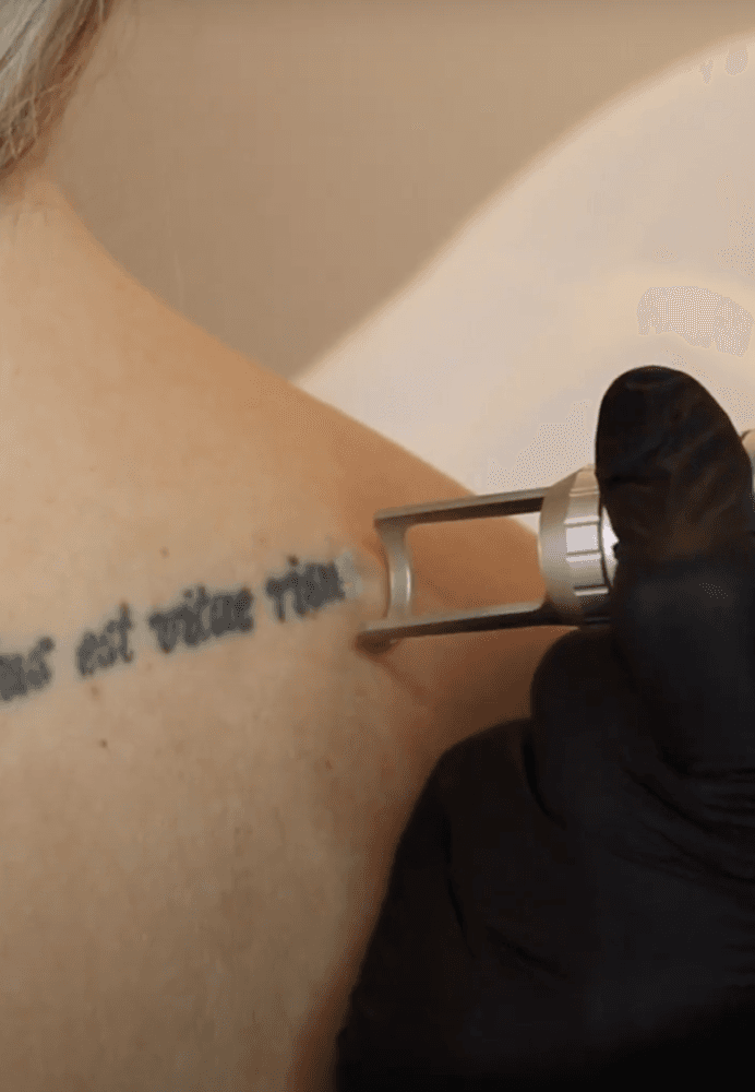 Tatovering bliver fjernet med pico laser