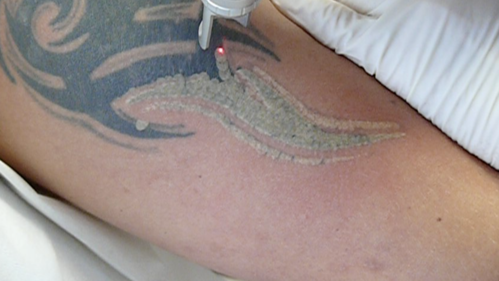 Få fjernet din uønskede tatovering i Silkeborg